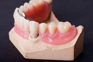 dental wax model