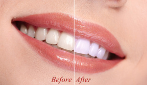 woman smiling with her teeth before and after