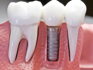 Dental Implants procedure