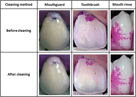 Dental Bone Grafting Material